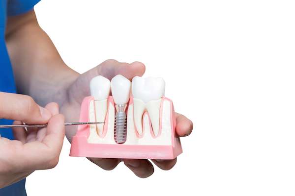 Can You Get Dental Implants if You Have Gum Disease from Vogue Dental in Peoria, IL