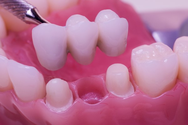 Are Dental Bridges Effective For Replacing Missing Teeth?