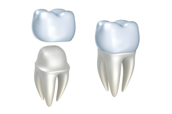 What To Expect During A Dental Crown Procedure