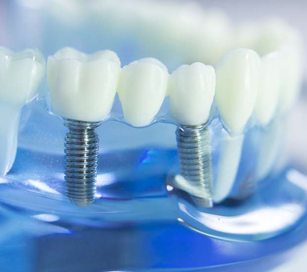 Peoria Dental Implants