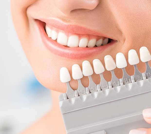 Peoria Dental Veneers and Dental Laminates