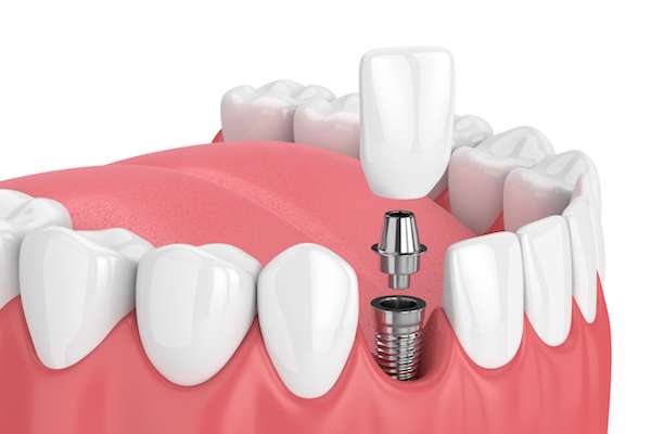 How Painful is Dental Implant Surgery from Vogue Dental in Peoria, IL