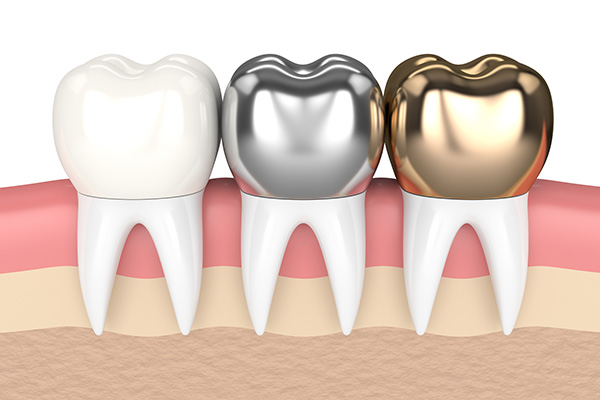 Metal Crowns vs. Porcelain Dental Crowns from Vogue Dental in Peoria, IL