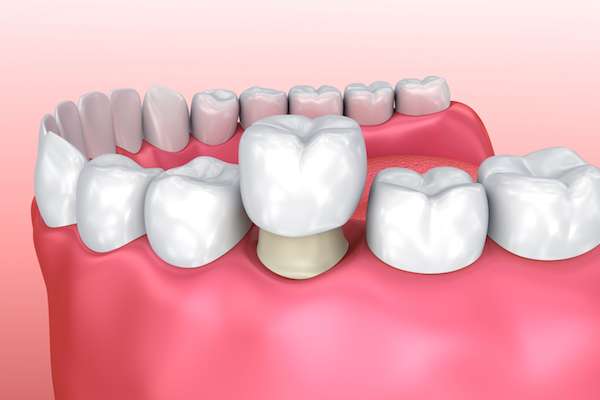 Permanent Dental Crowns vs. Temporary: Is There a Difference from Vogue Dental in Peoria, IL