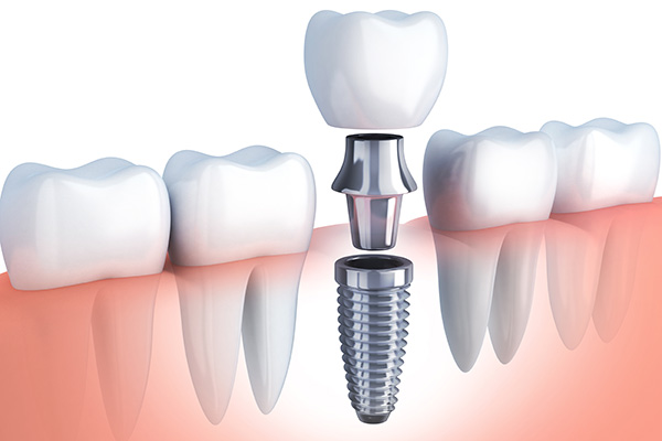 Questions to Ask Your Implant Dentist from Vogue Dental in Peoria, IL