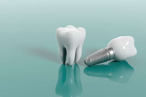 Multiple Teeth Replacement Options: One Implant for Two Teeth from Vogue Dental in Peoria, IL
