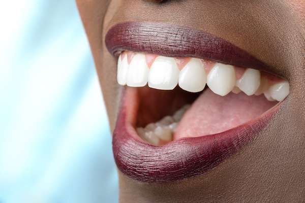 Routine Dental Care: What Are Tooth Colored Fillings from Vogue Dental in Peoria, IL